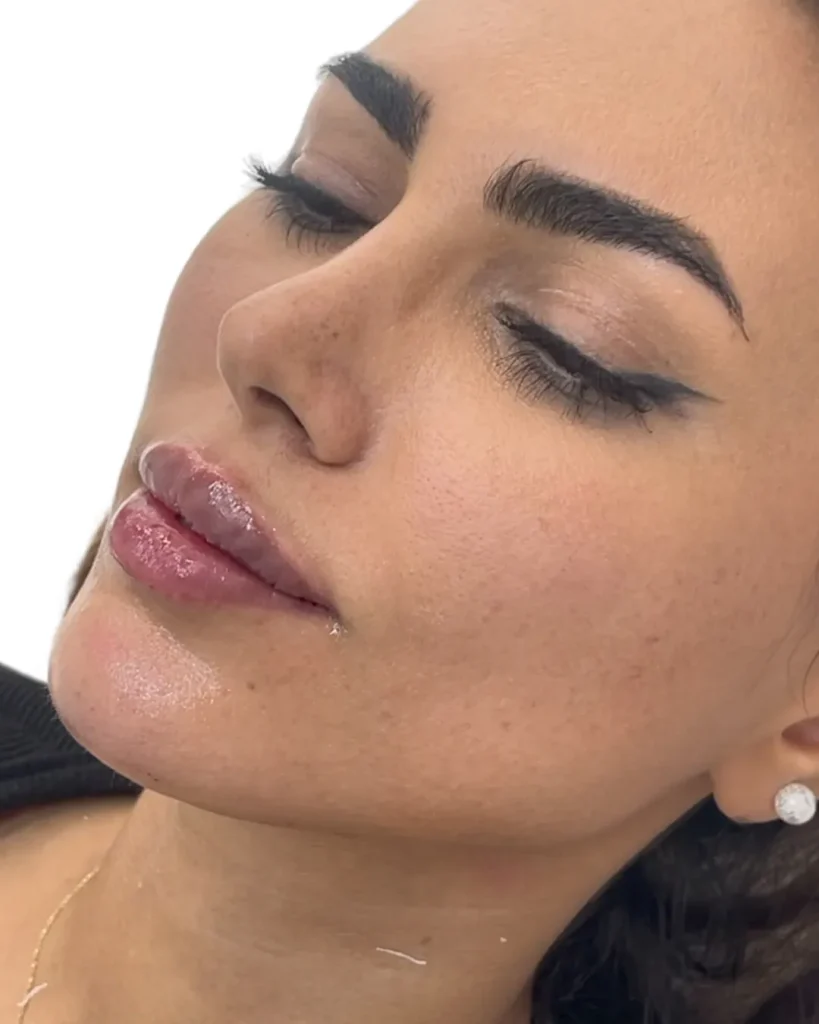 عکس بعد از تزریق فیلر لب توسط دکتر رضا مهاجری