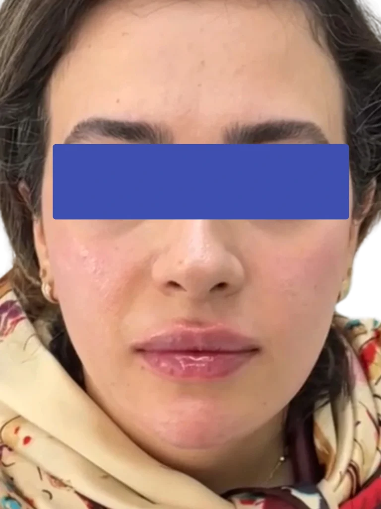 تزریق فیلر فول فیس